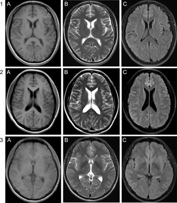 Neurosyphilis with ocular involvement and normal magnetic resonance imaging results affirmed by metagenomic next-generation sequencing